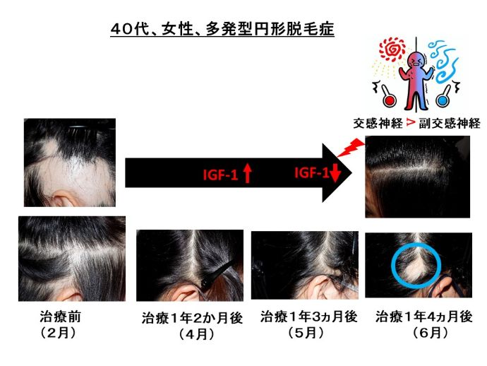 円形脱毛症　病院
